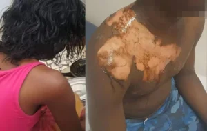 Drame conjugal à Touba : un homme grièvement brûlé à l’huile chaude par son épouse