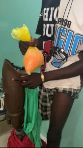 Trafic de drogues : une mule handicapée moteur tombe à Karang avec de l’ecstasy dans la prothèse de jambe
